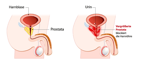 Prostatavergrößerung